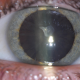 teaser cataract