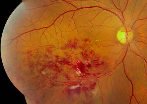 retinal vein occlusion with marathon